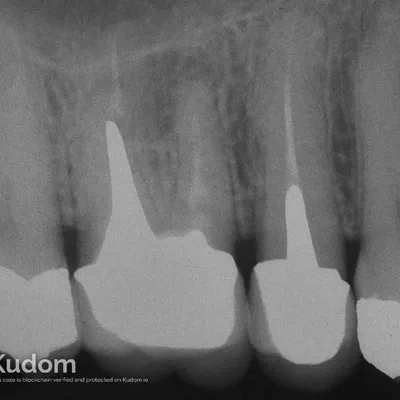 Microchirurgia Apicale Radice Mesio-Vestibolare di Molare Superiore - Immagine 1