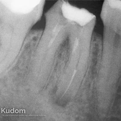 Perforazione Iatrogena Molare Inferiore - Immagine 1