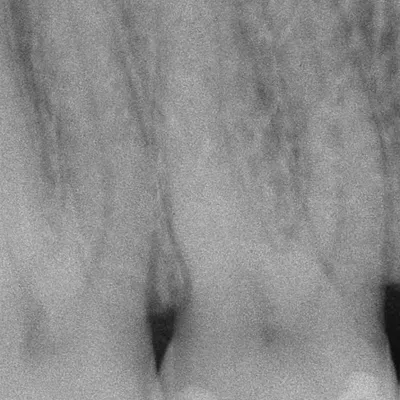 Terapia Canalare Molare Superiore - Immagine 1