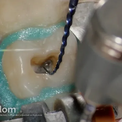 Terapia Canalare Molare Superiore - Immagine 10