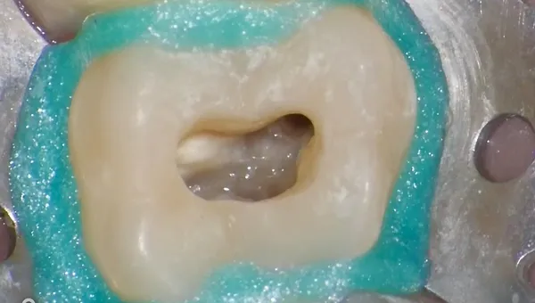 Terapia Canalare Molare Superiore