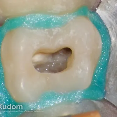 Terapia Canalare Molare Superiore - Immagine 11