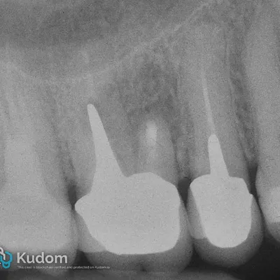 Microchirurgia Apicale Radice Mesio-Vestibolare di Molare Superiore - Immagine 11