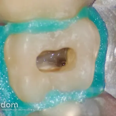 Terapia Canalare Molare Superiore - Immagine 12