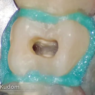 Terapia Canalare Molare Superiore - Immagine 13