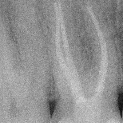 Terapia Canalare Molare Superiore - Immagine 14