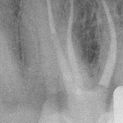 Terapia Canalare Molare Superiore - Immagine 15