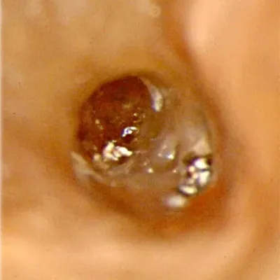 Perforazione Iatrogena Molare Inferiore - Immagine 2
