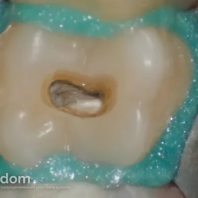 Terapia Canalare Molare Superiore - Immagine 3