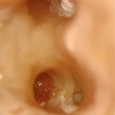 Perforazione Iatrogena Molare Inferiore - Immagine 3