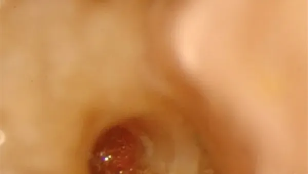Perforazione Iatrogena Molare Inferiore