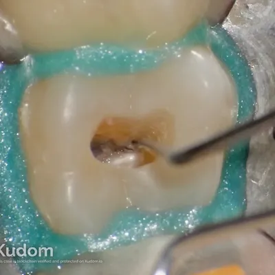 Terapia Canalare Molare Superiore - Immagine 4