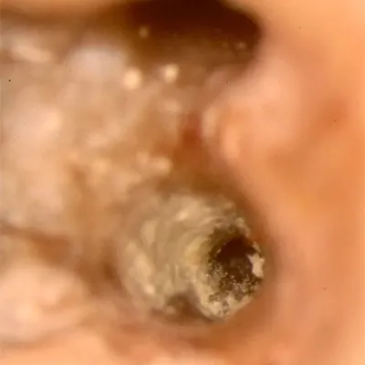 Perforazione Iatrogena Molare Inferiore - Immagine 4