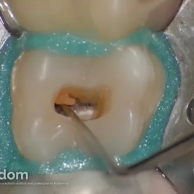 Terapia Canalare Molare Superiore - Immagine 5