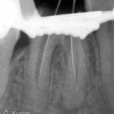 Perforazione Iatrogena Molare Inferiore - Immagine 5