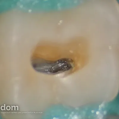 Terapia Canalare Molare Superiore - Immagine 6