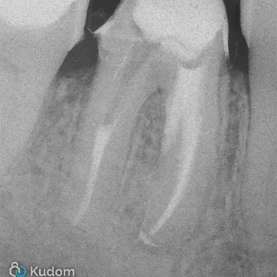 Perforazione Iatrogena Molare Inferiore - Immagine 6