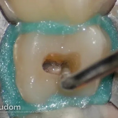 Terapia Canalare Molare Superiore - Immagine 7