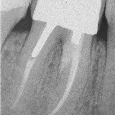Perforazione Iatrogena Molare Inferiore - Immagine 7