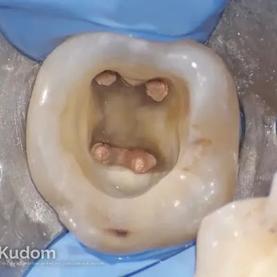 Ritrattamento Complesso Molare Inferiore - Immagine 7