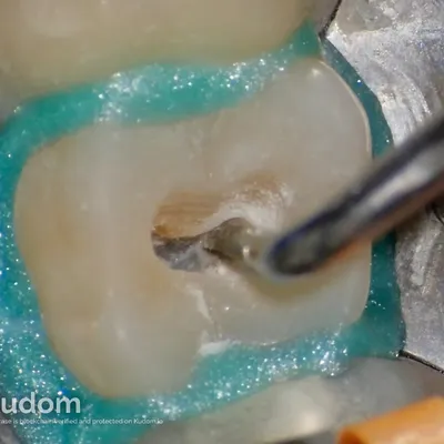 Terapia Canalare Molare Superiore - Immagine 8