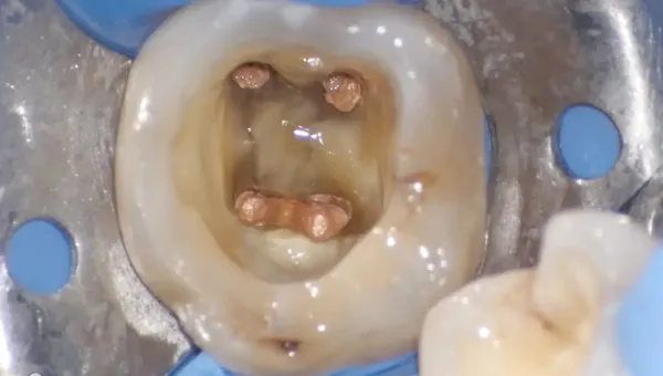 Ritrattamento Complesso Molare Inferiore
