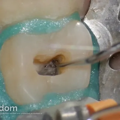 Terapia Canalare Molare Superiore - Immagine 9