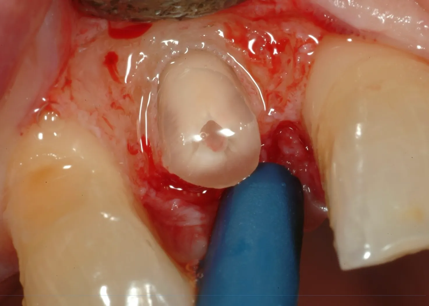 Allungamento Corona Clinica