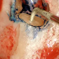 Microchirurgia Endodontica